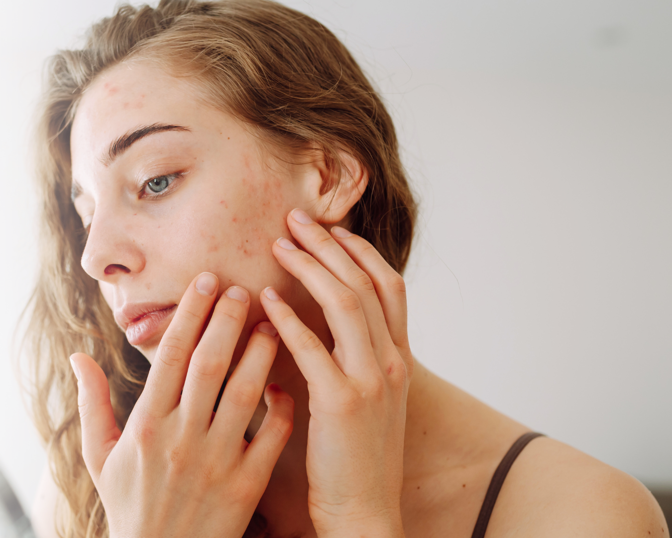 Microneedling hos Klinik Skin Rehab i Charlottenlund