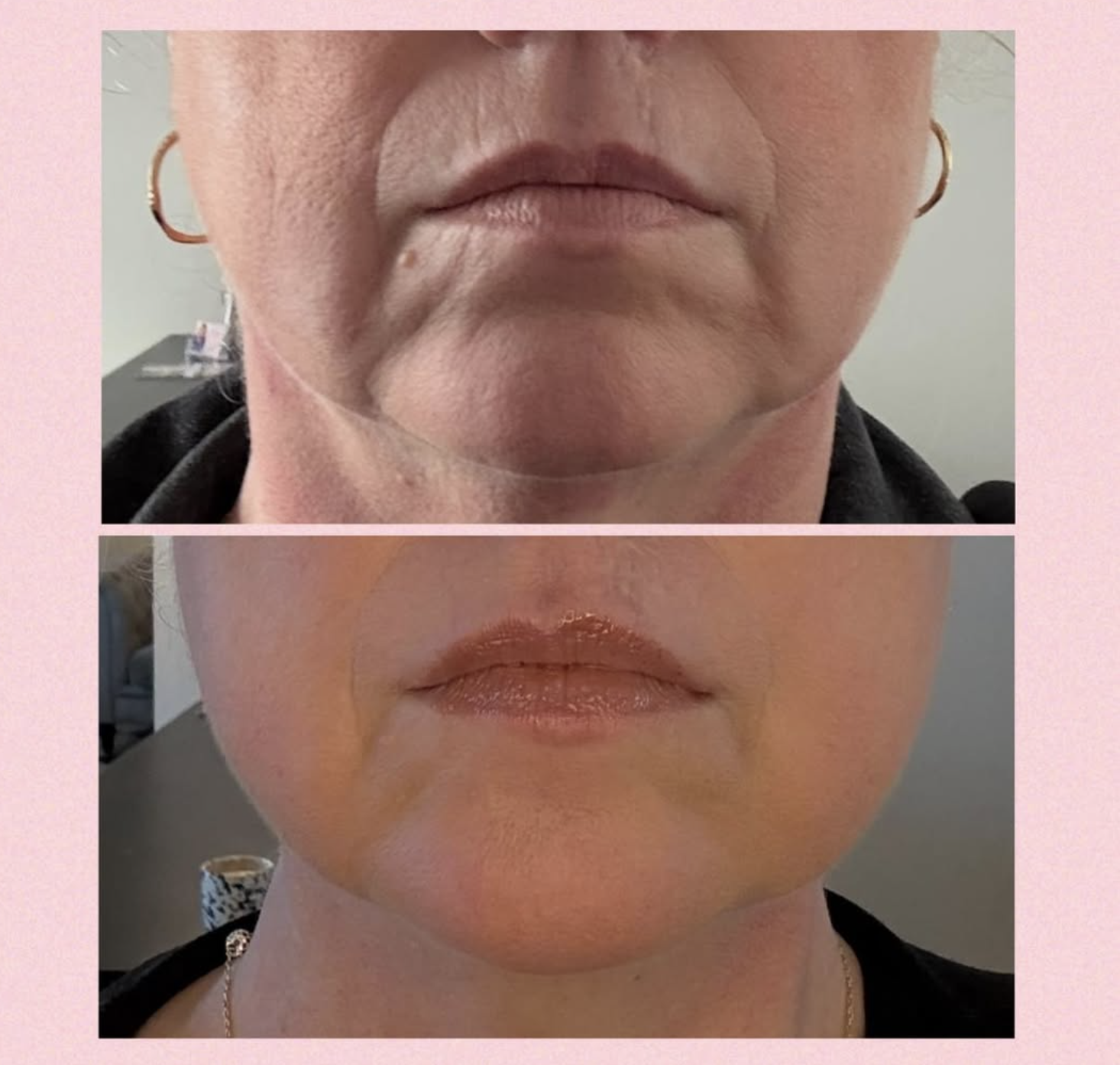 Naturlig botox behandling hos Klinik Skin Rehab i Charlottenlund