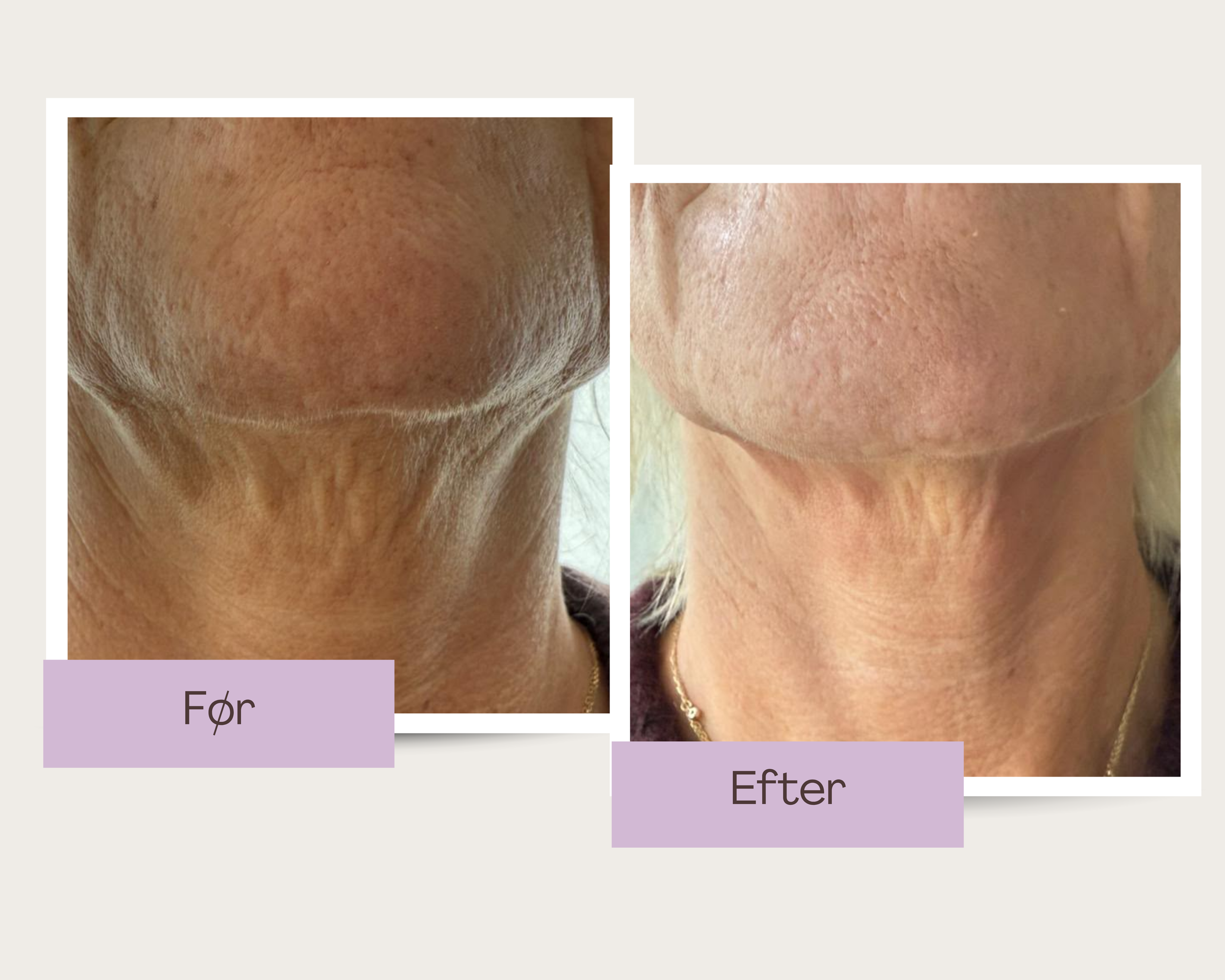 EMS behandling hos Klinik Skin Rehab i Charlottenlund