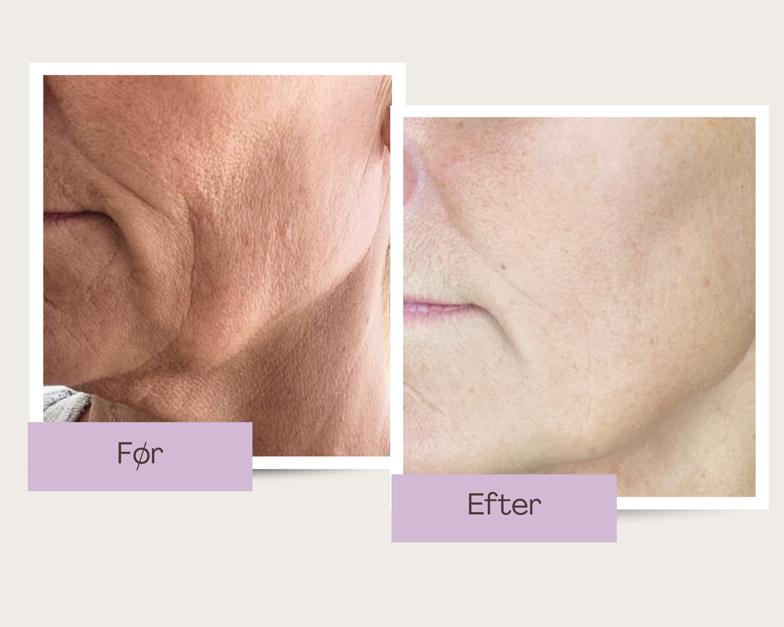 EMS behandling hos Klinik Skin Rehab i Charlottenlund
