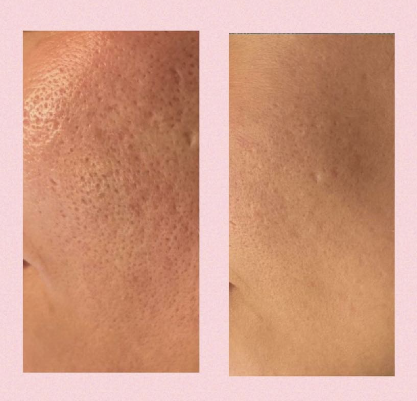Microneedling hos Klinik Skin Rehab i Charlottenlund