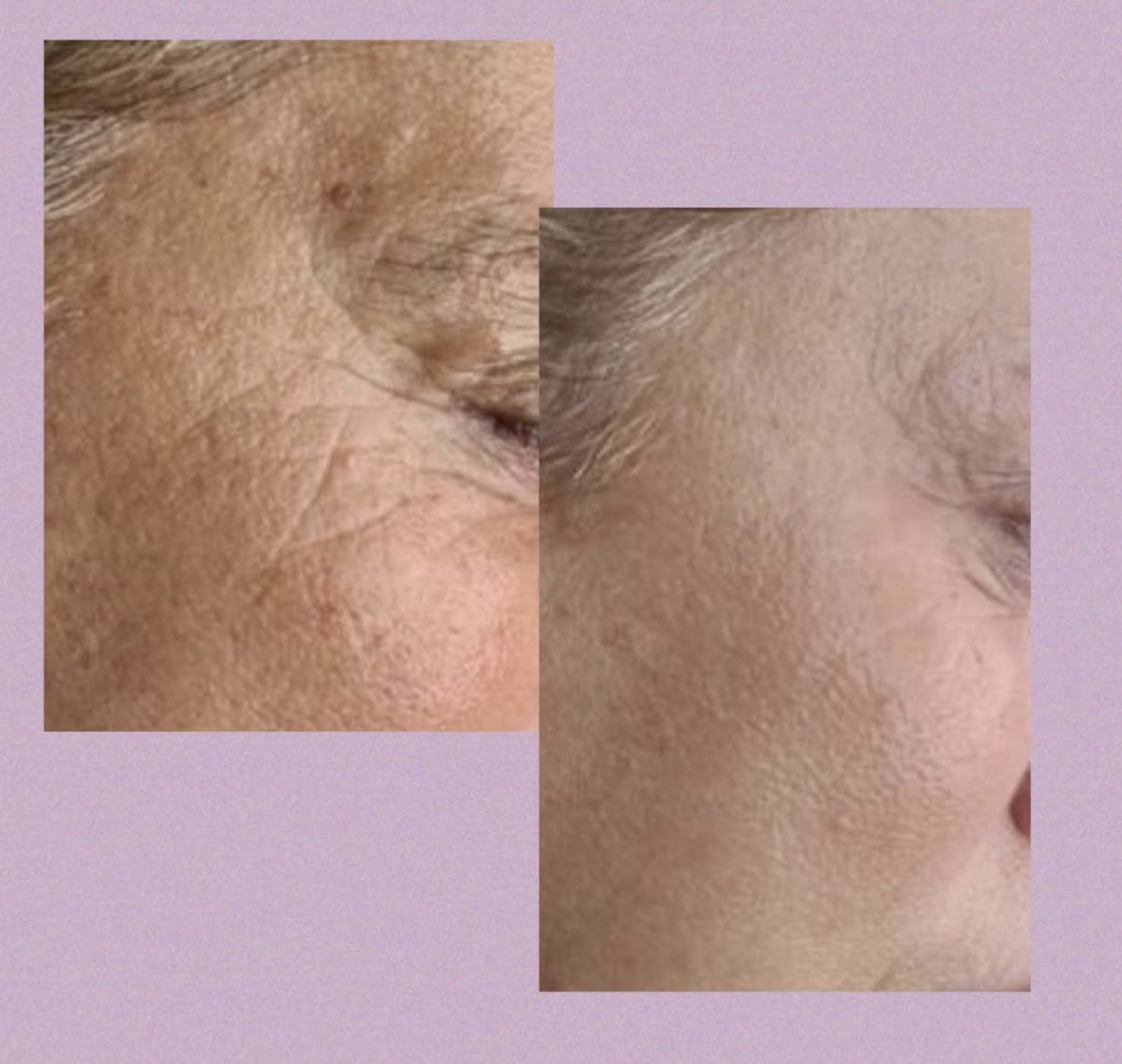 Før og efter billeder Klinik Skin Rehab i Charlottenlund og på Bornholm.