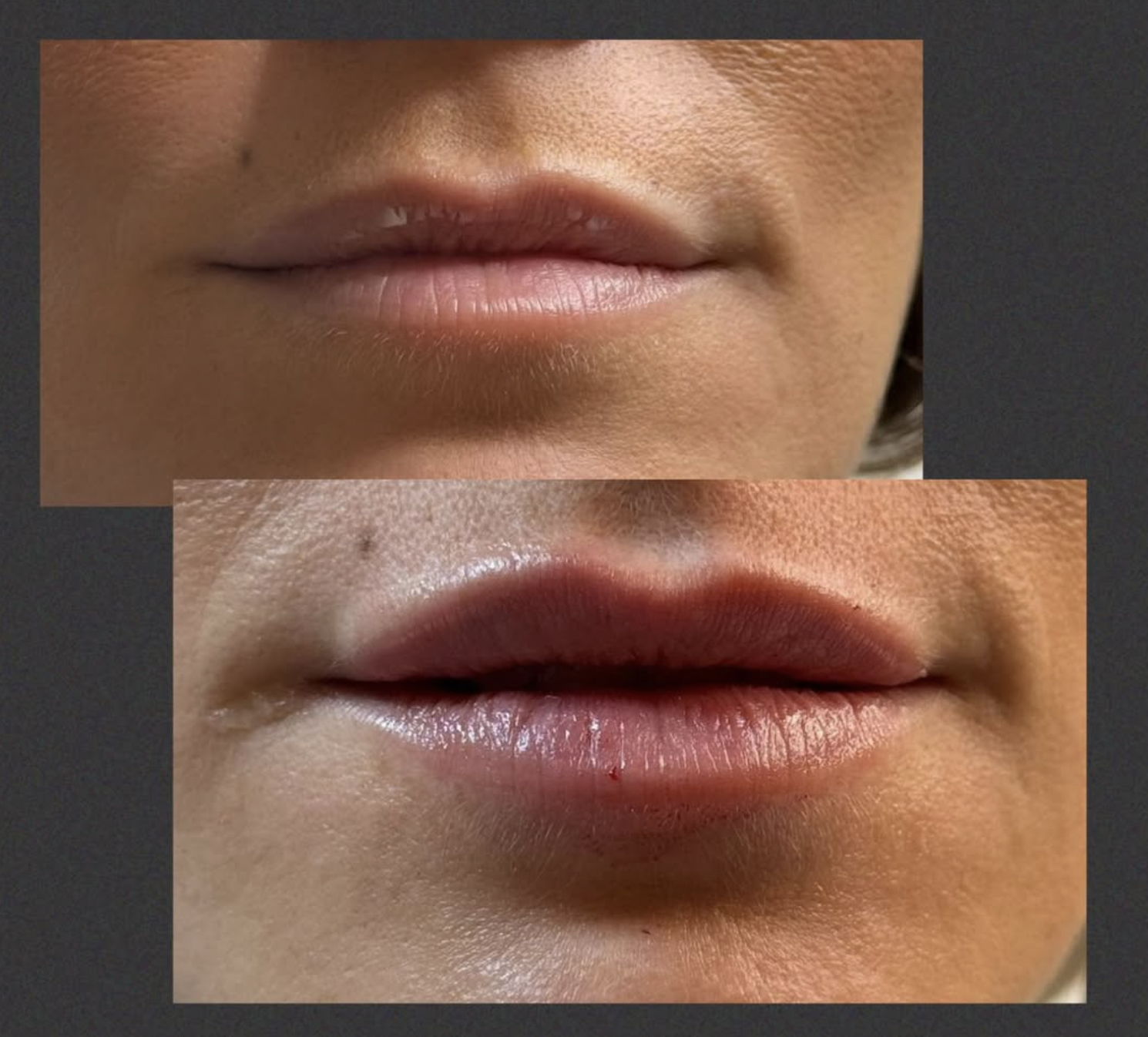 Naturlig filler behandling hos Klinik Skin Rehab i Charlottenlund