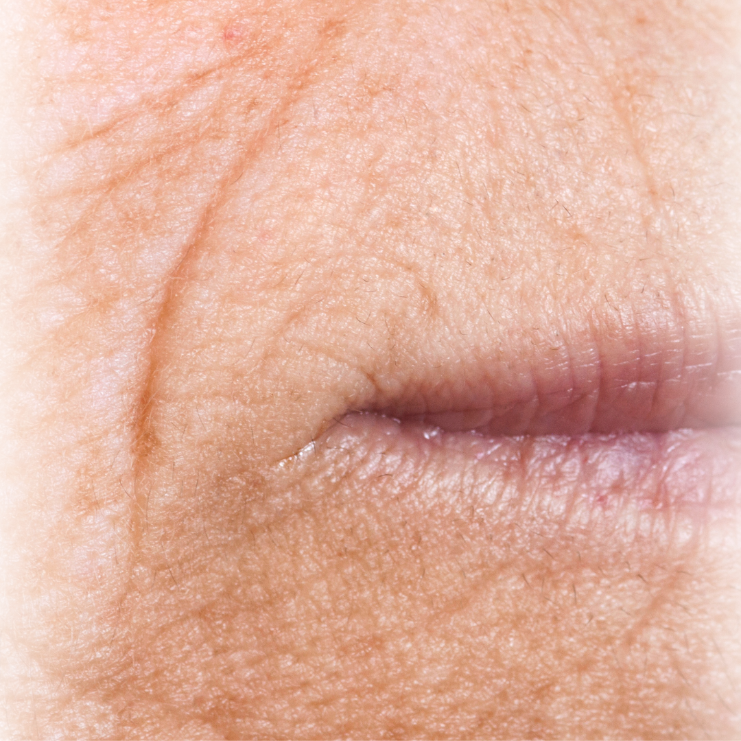 Naturlig botox behandling hos Klinik Skin Rehab i Charlottenlund