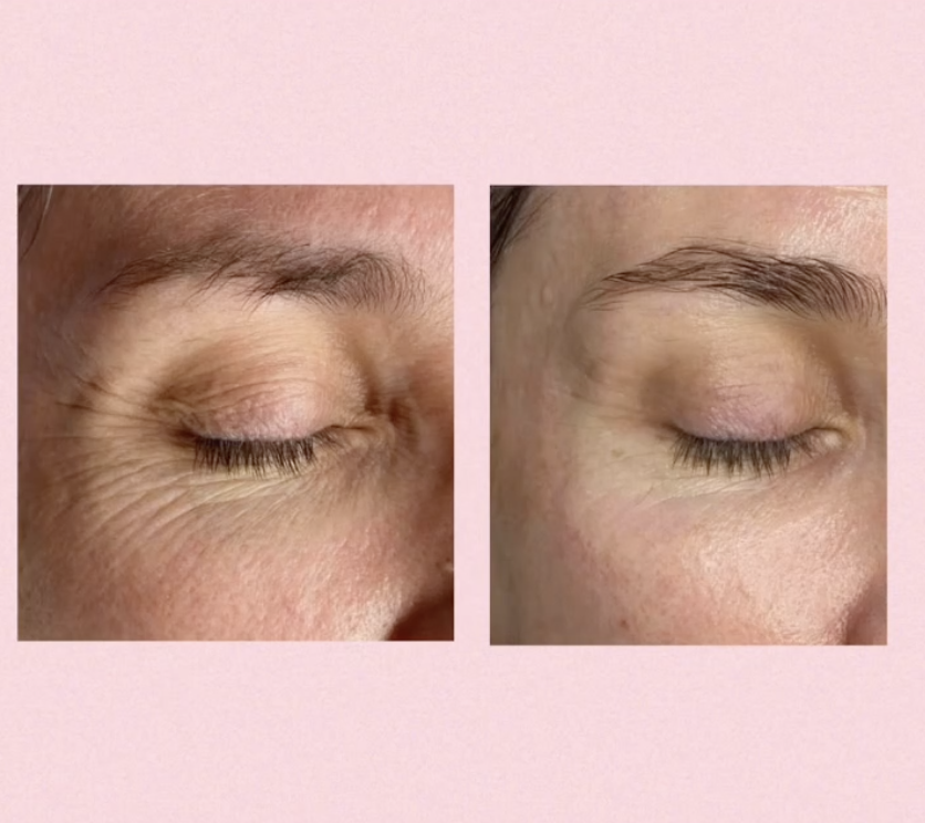 Peelings hos Klinik Skin Rehab i Charlottenlund