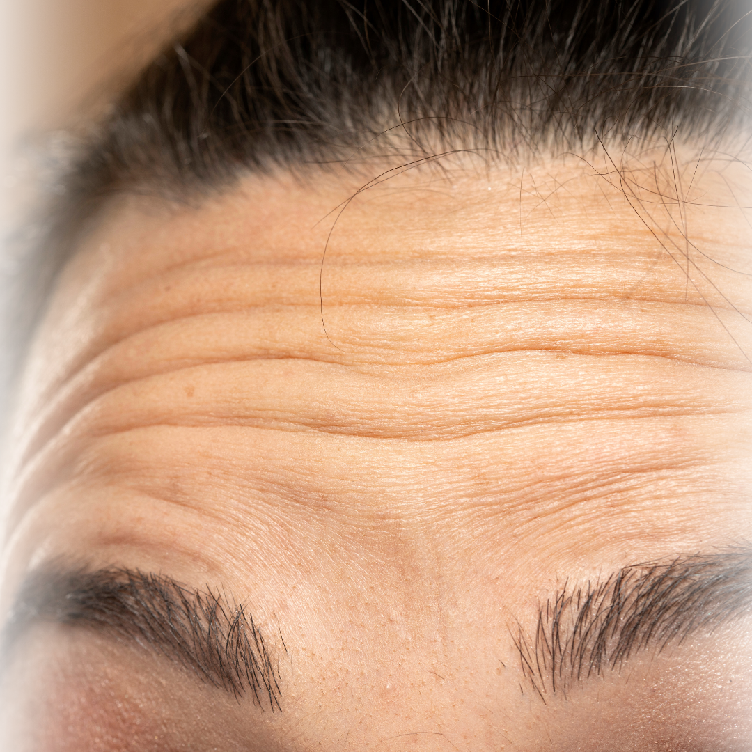 Naturlig botox behandling hos Klinik Skin Rehab i Charlottenlund