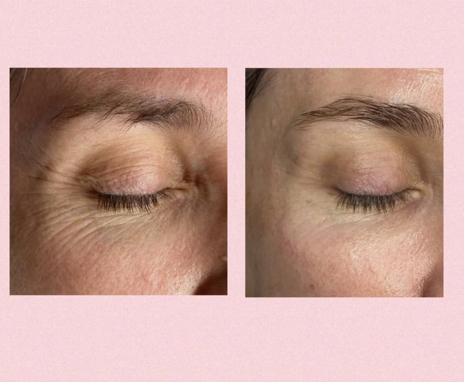 Peelings hos Klinik Skin Rehab i Charlottenlund