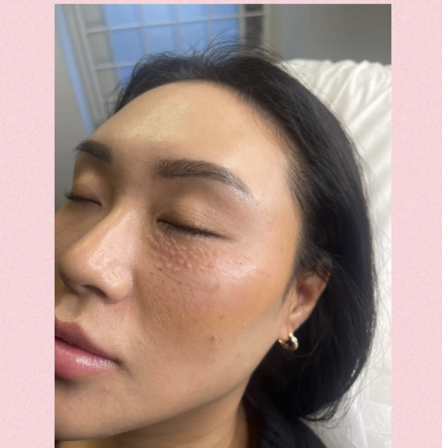 Før og efter billeder Klinik Skin Rehab i Charlottenlund og på Bornholm.