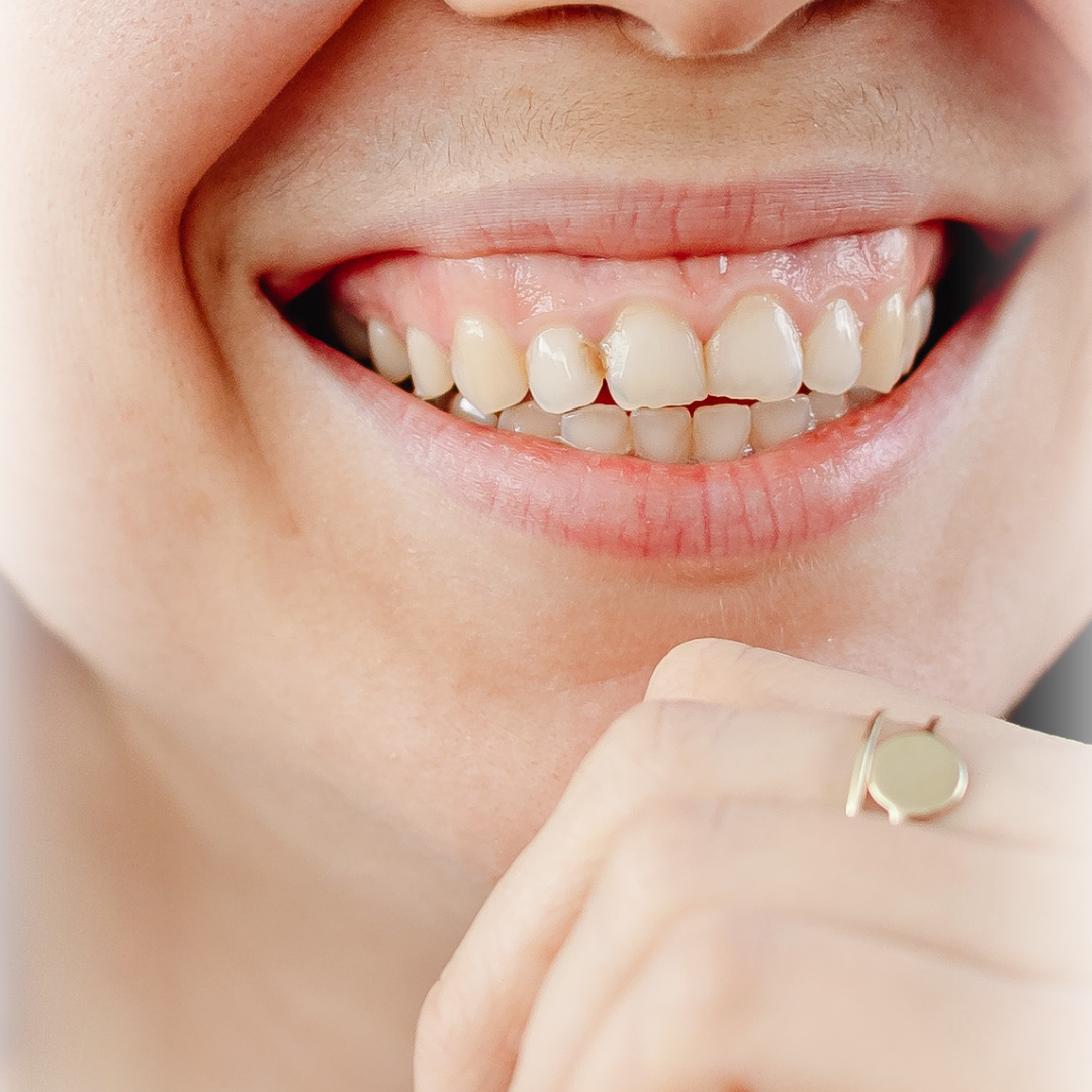 Naturlig botox behandling hos Klinik Skin Rehab i Charlottenlund