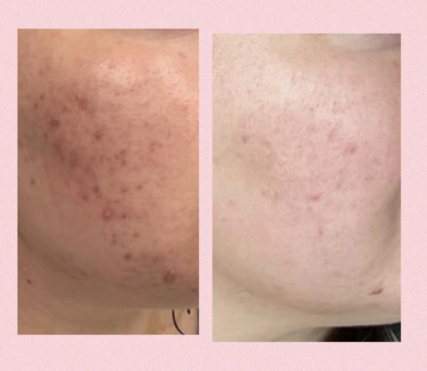 Microneedling hos Klinik Skin Rehab i Charlottenlund