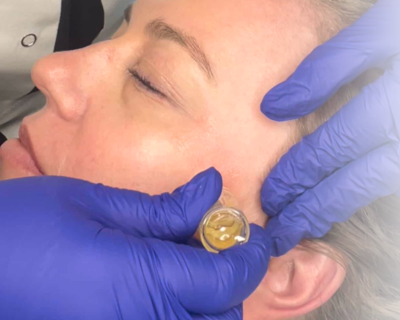 Microgold/Tox hos Klinik Skin Rehab i Charlottenlund