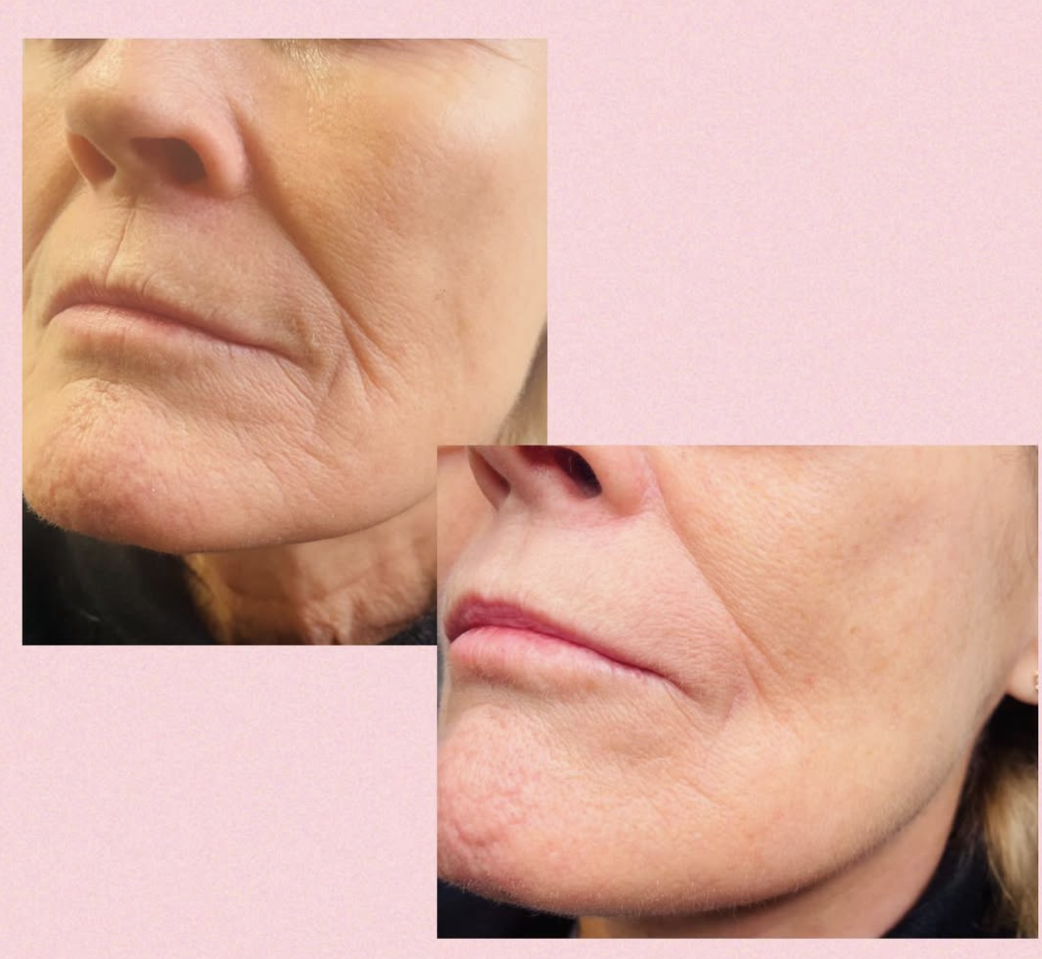 Skinbooster behandling hos Klinik Skin Rehab i Charlottenlund