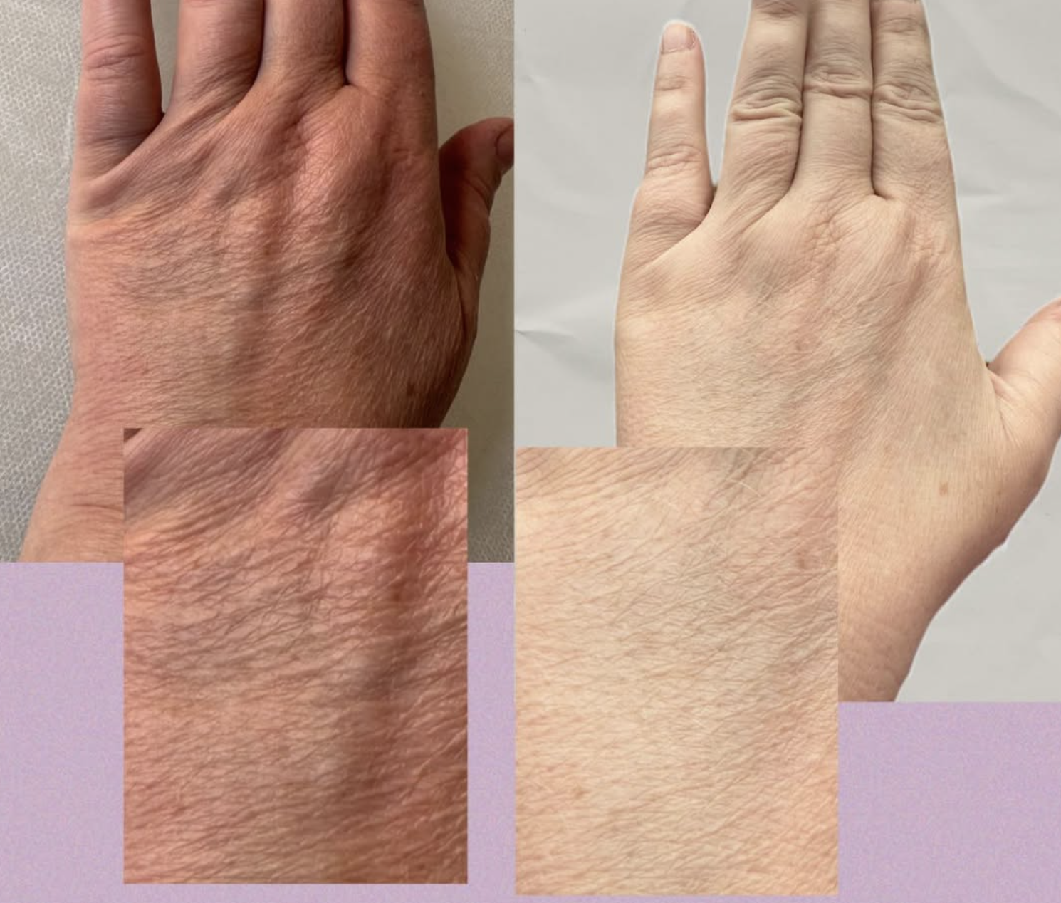 Skinbooster behandling hos Klinik Skin Rehab i Charlottenlund