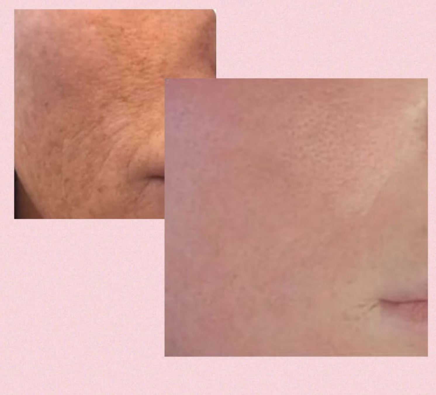 Før og efter billeder Klinik Skin Rehab i Charlottenlund og på Bornholm.