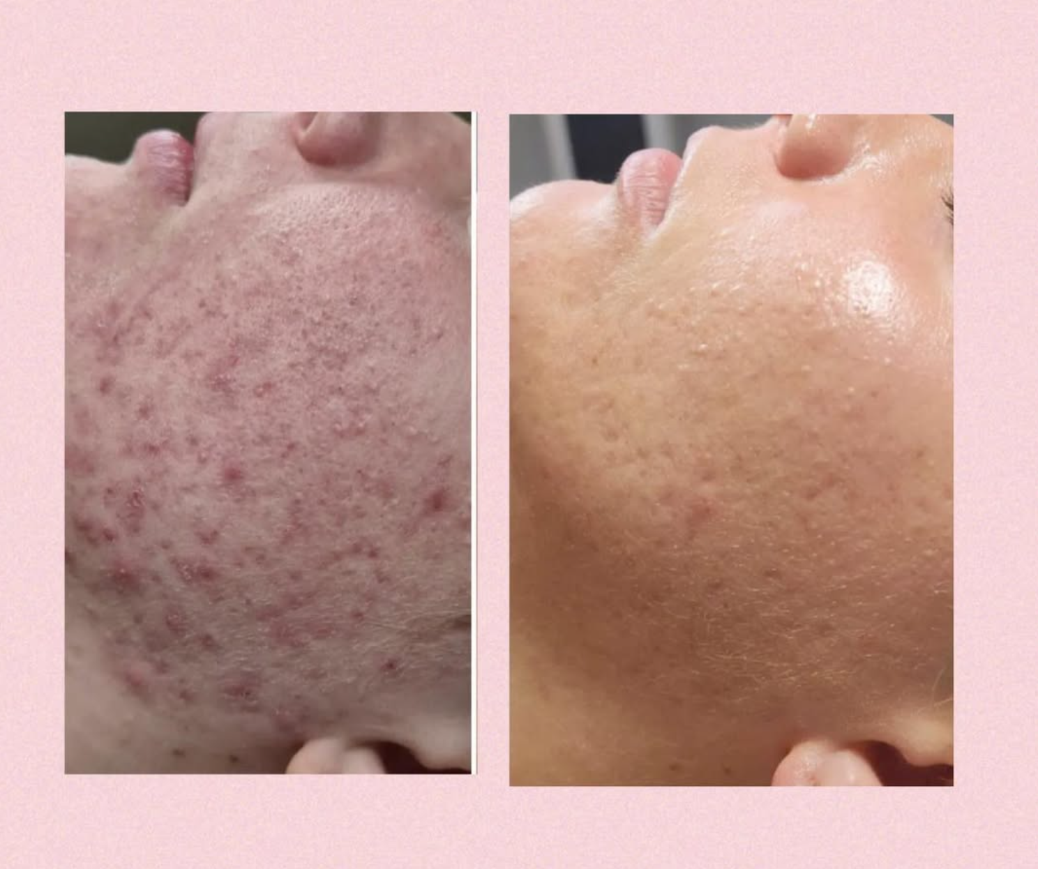 Peelings hos Klinik Skin Rehab i Charlottenlund