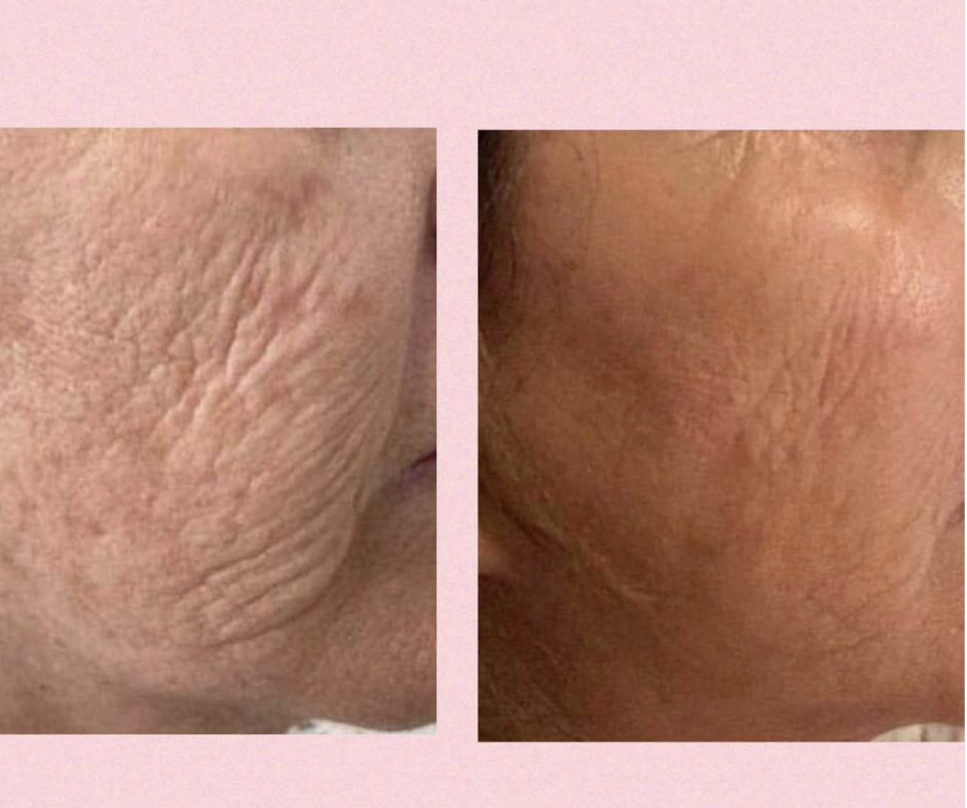 Profhilo behandling hos Klinik Skin Rehab i Charlottenlund