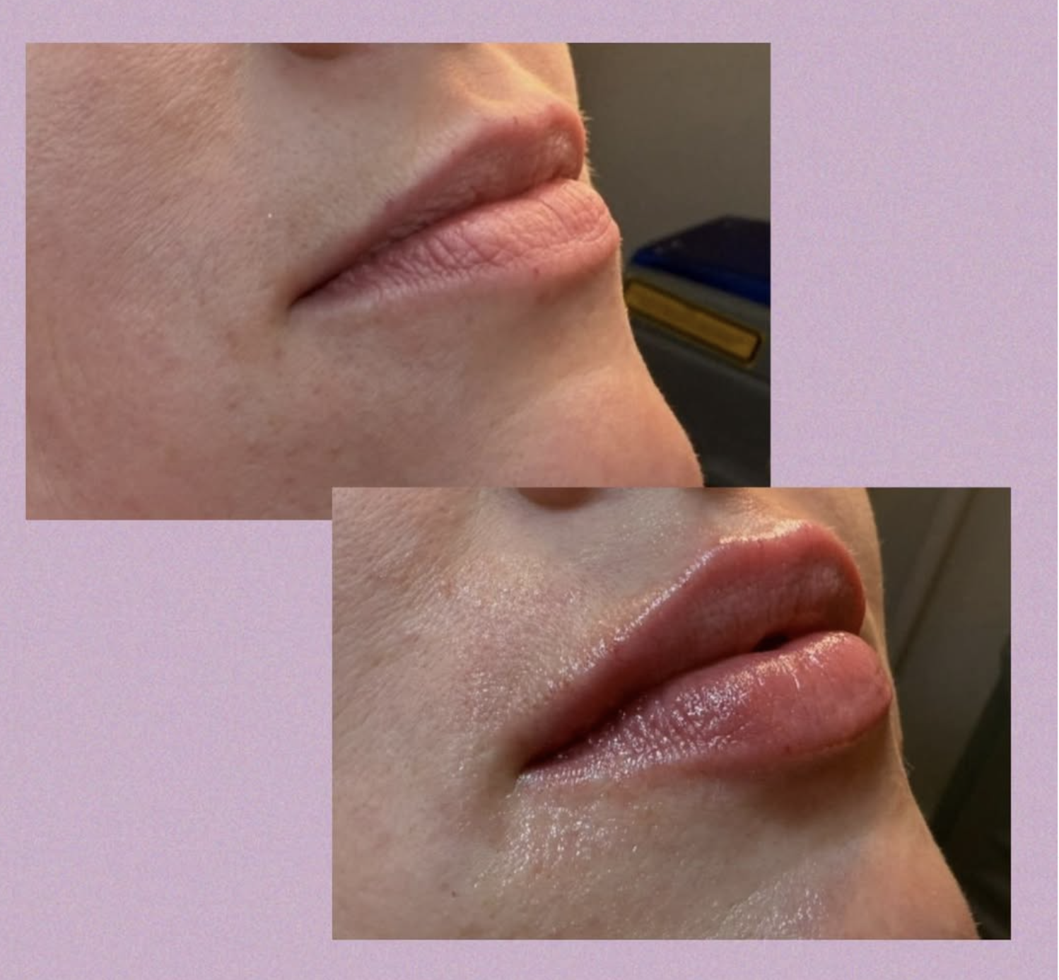 Naturlig filler behandling hos Klinik Skin Rehab i Charlottenlund