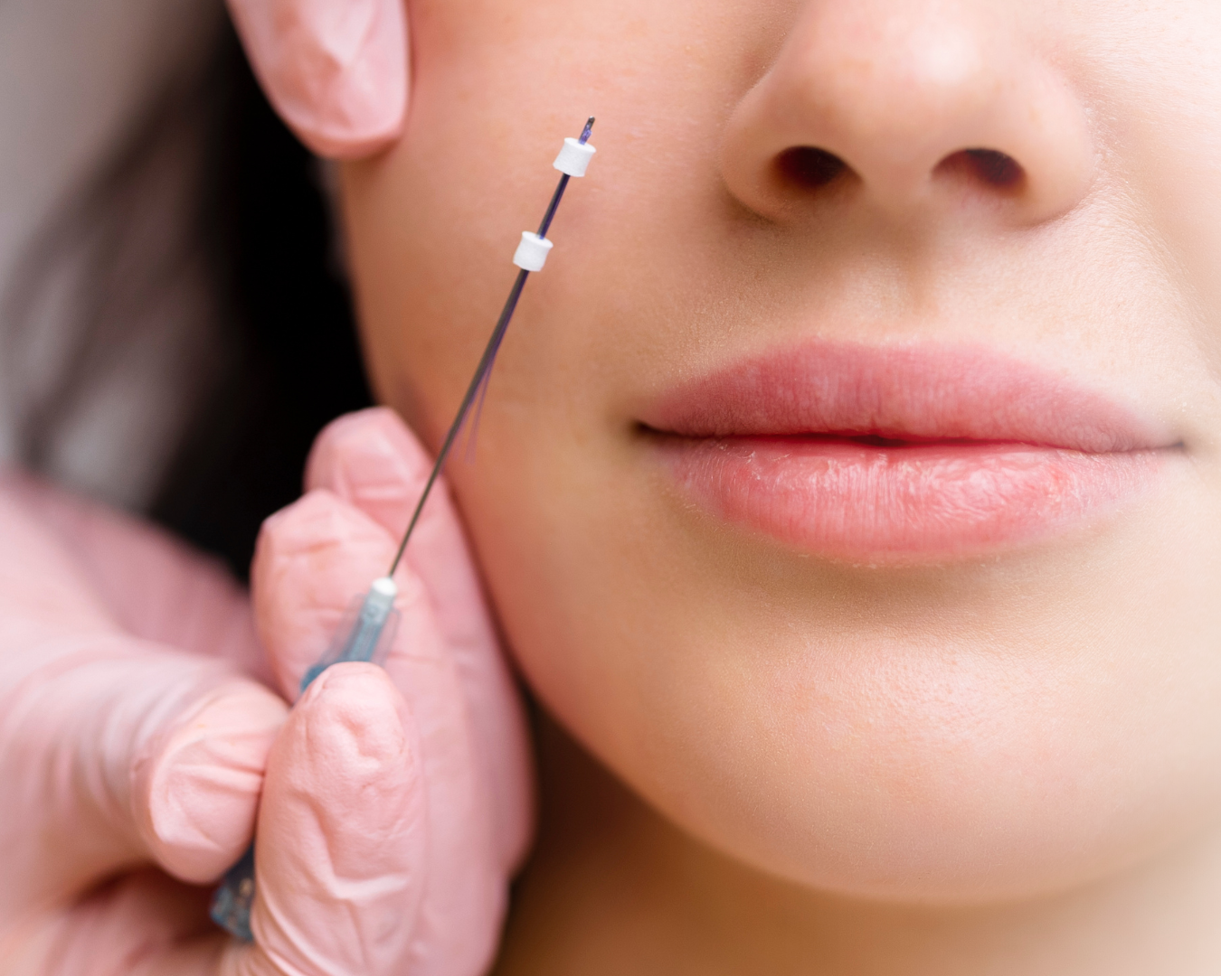 Kollagen tråde hos Klinik Skin Rehab i Charlottenlund