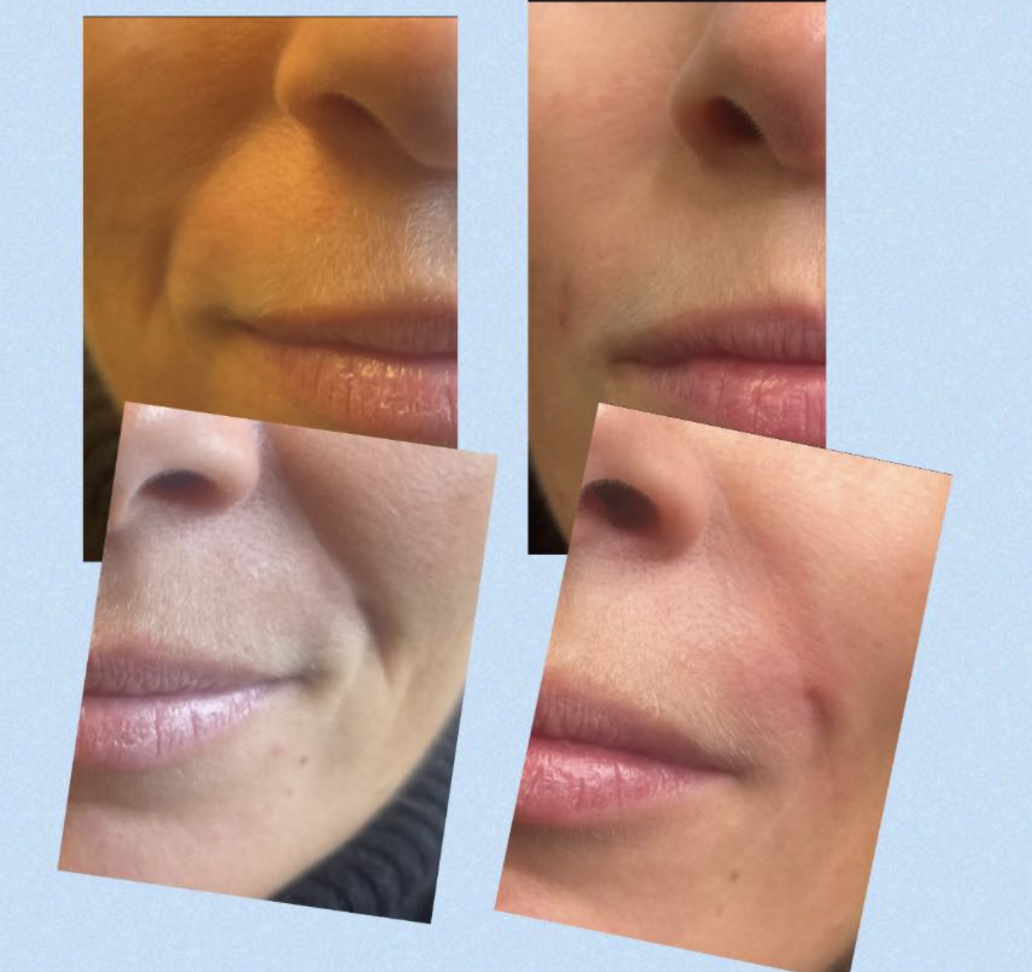 Naturlig filler behandling hos Klinik Skin Rehab i Charlottenlund