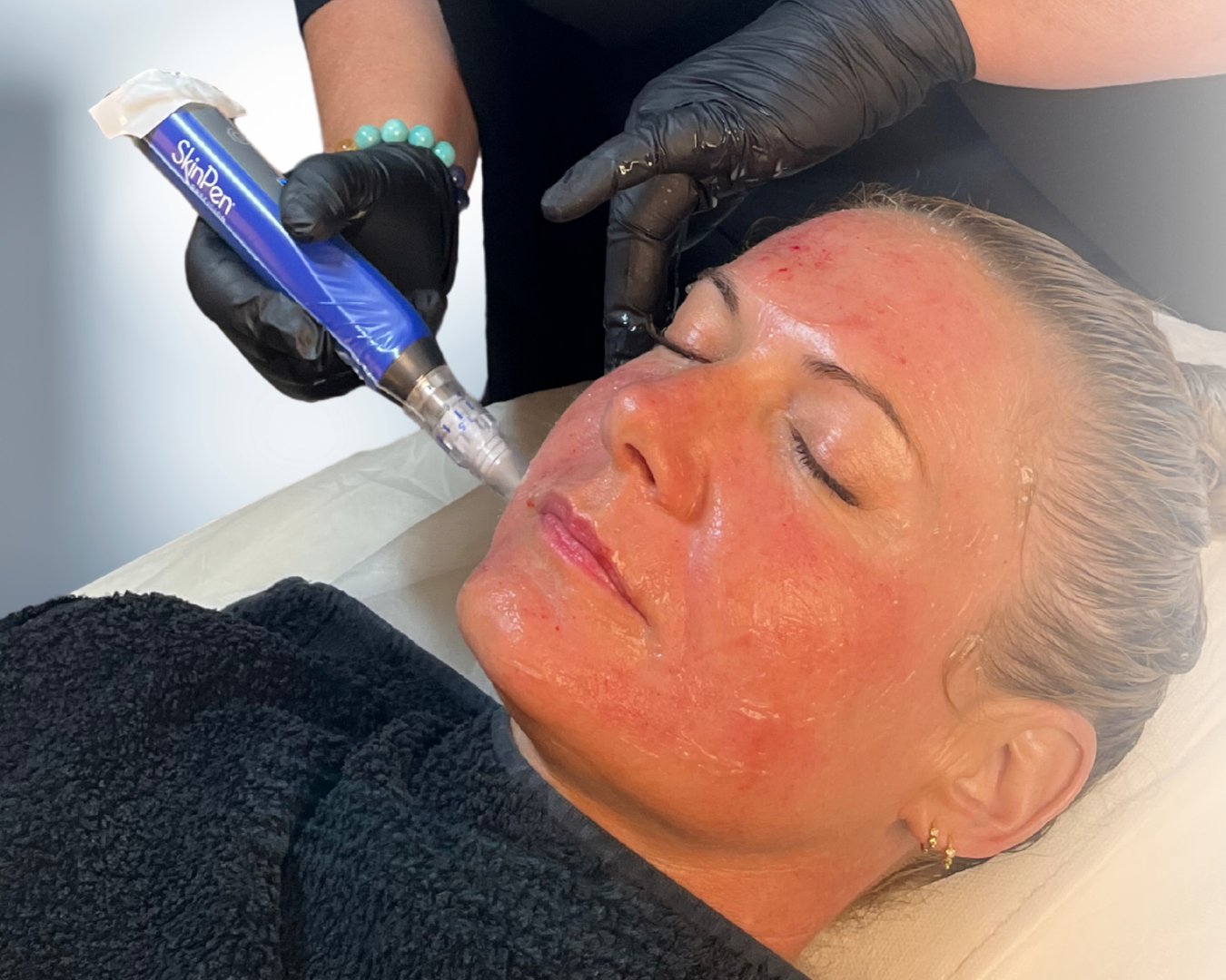 Kosmetisk klinik i Charlottenlund og Bornholm Klinik Skin Rehab microneedling