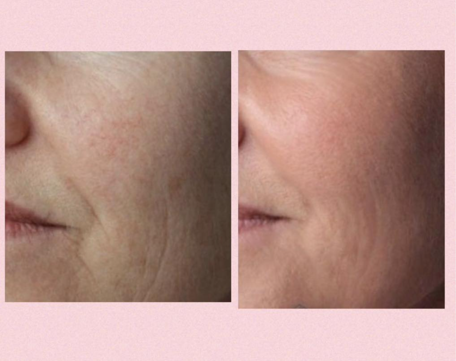 Profhilo behandling hos Klinik Skin Rehab i Charlottenlund