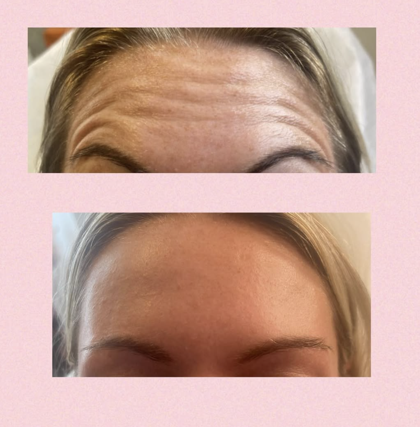 Naturlig botox behandling hos Klinik Skin Rehab i Charlottenlund