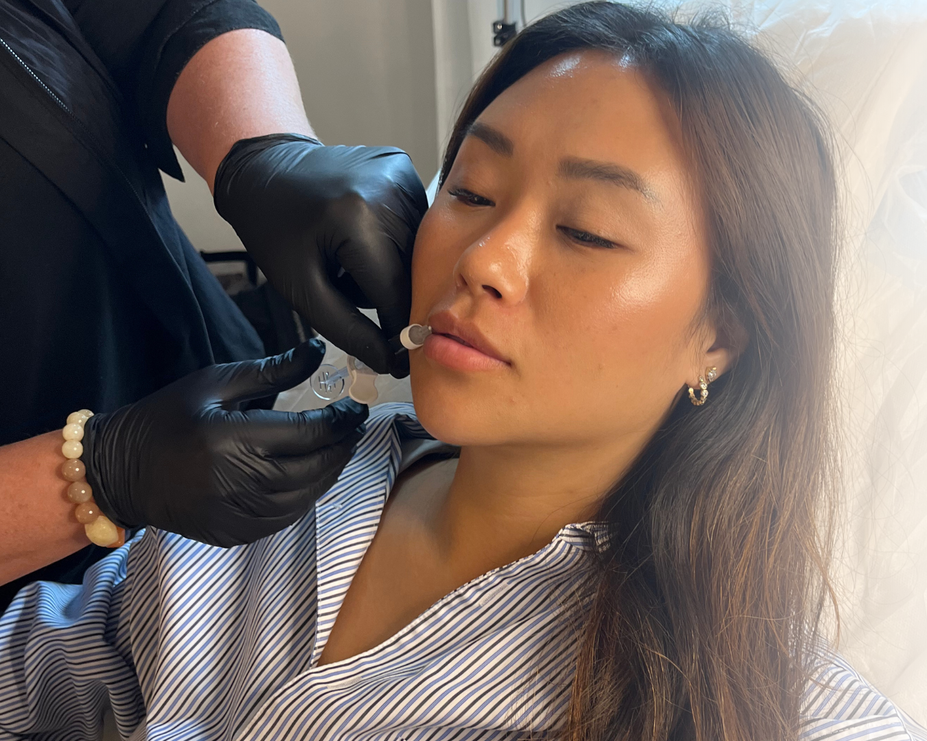 Filler Kosmetisk klinik i Charlottenlund og Bornholm Klinik Skin Rehab