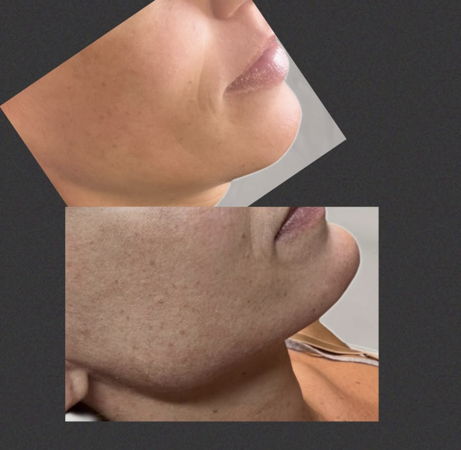 Naturlig filler behandling hos Klinik Skin Rehab i Charlottenlund