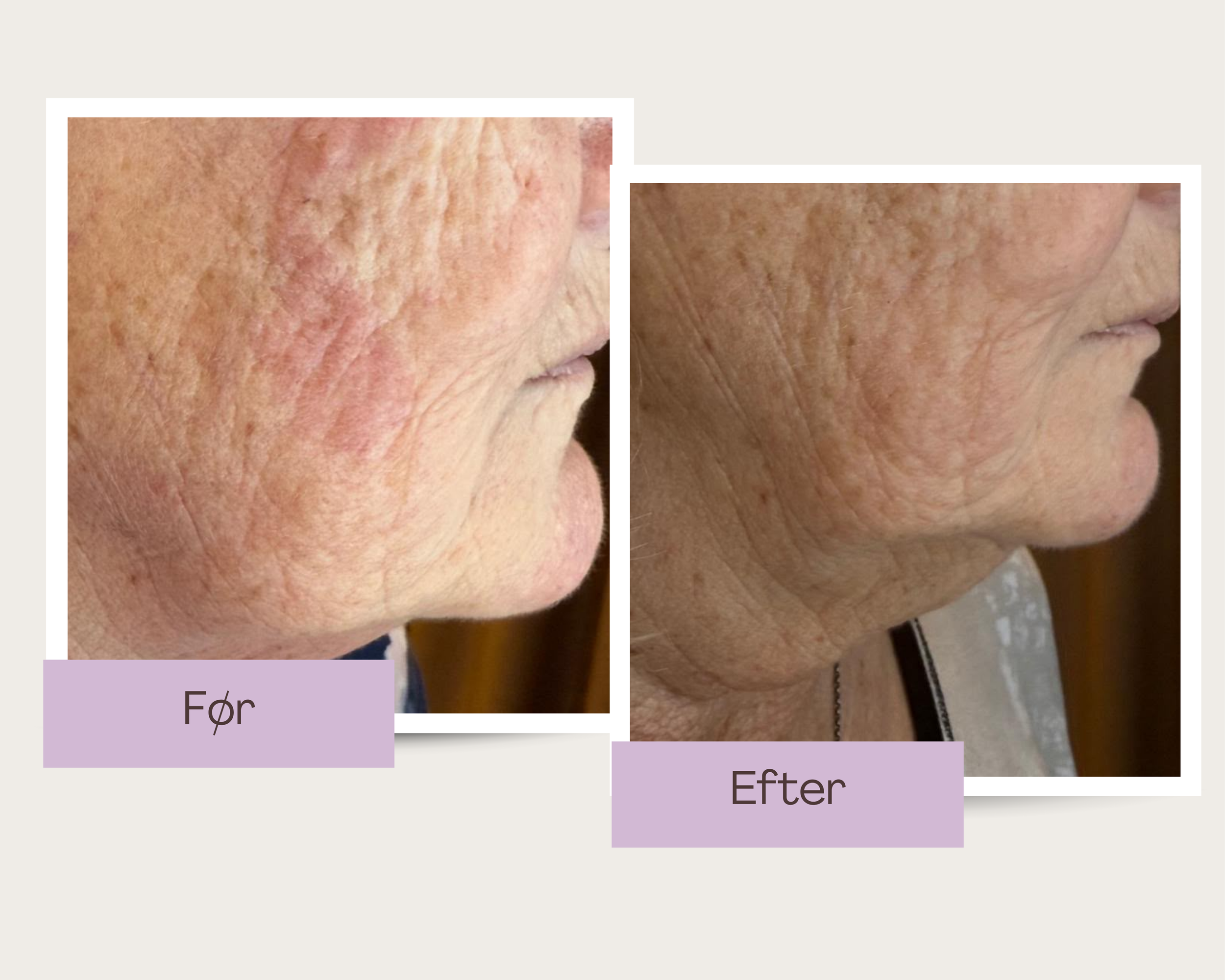 EMS behandling hos Klinik Skin Rehab i Charlottenlund