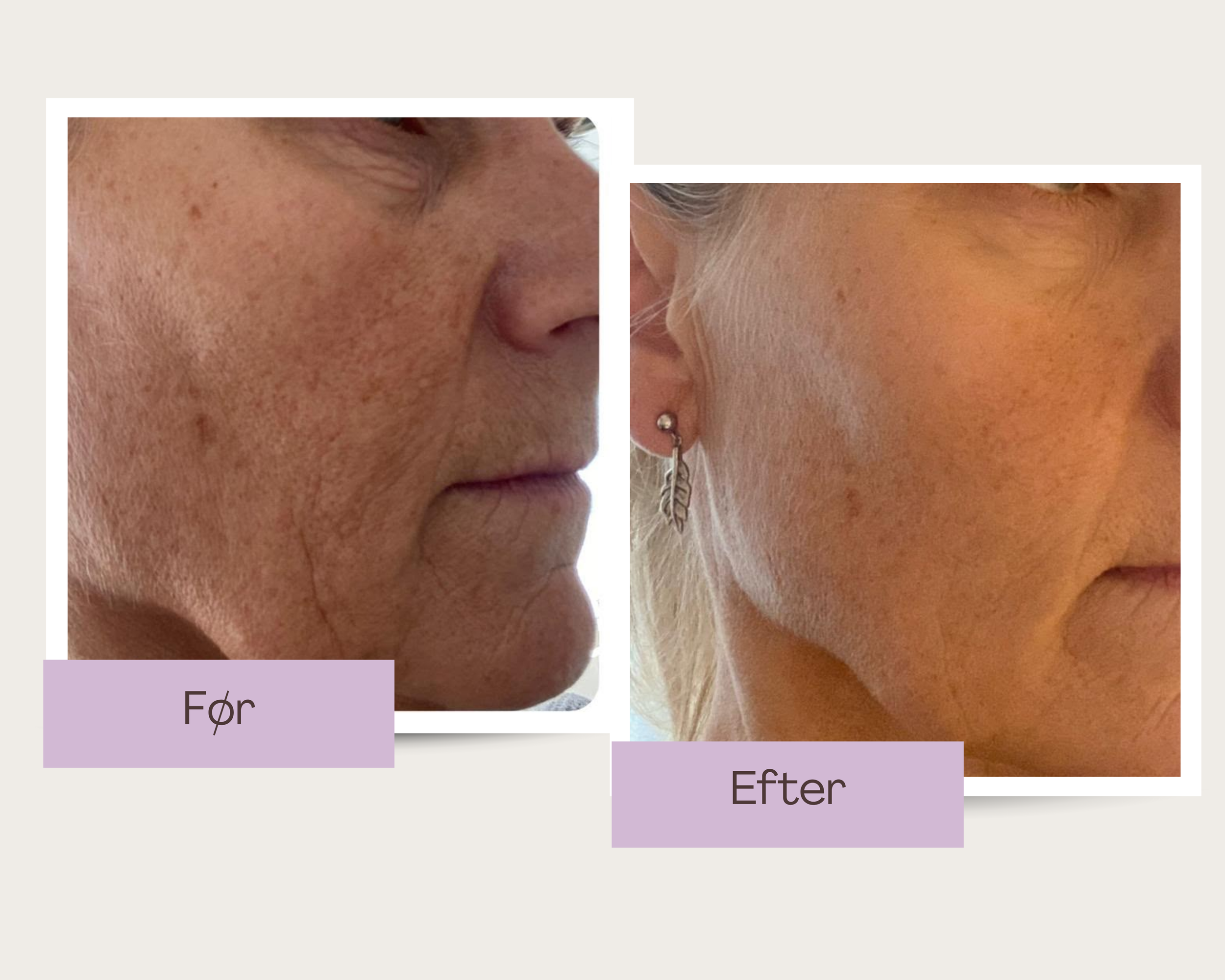 EMS behandling hos Klinik Skin Rehab i Charlottenlund