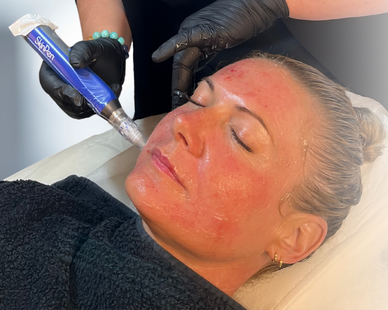 Microneedling hos Klinik Skin Rehab i Charlottenlund