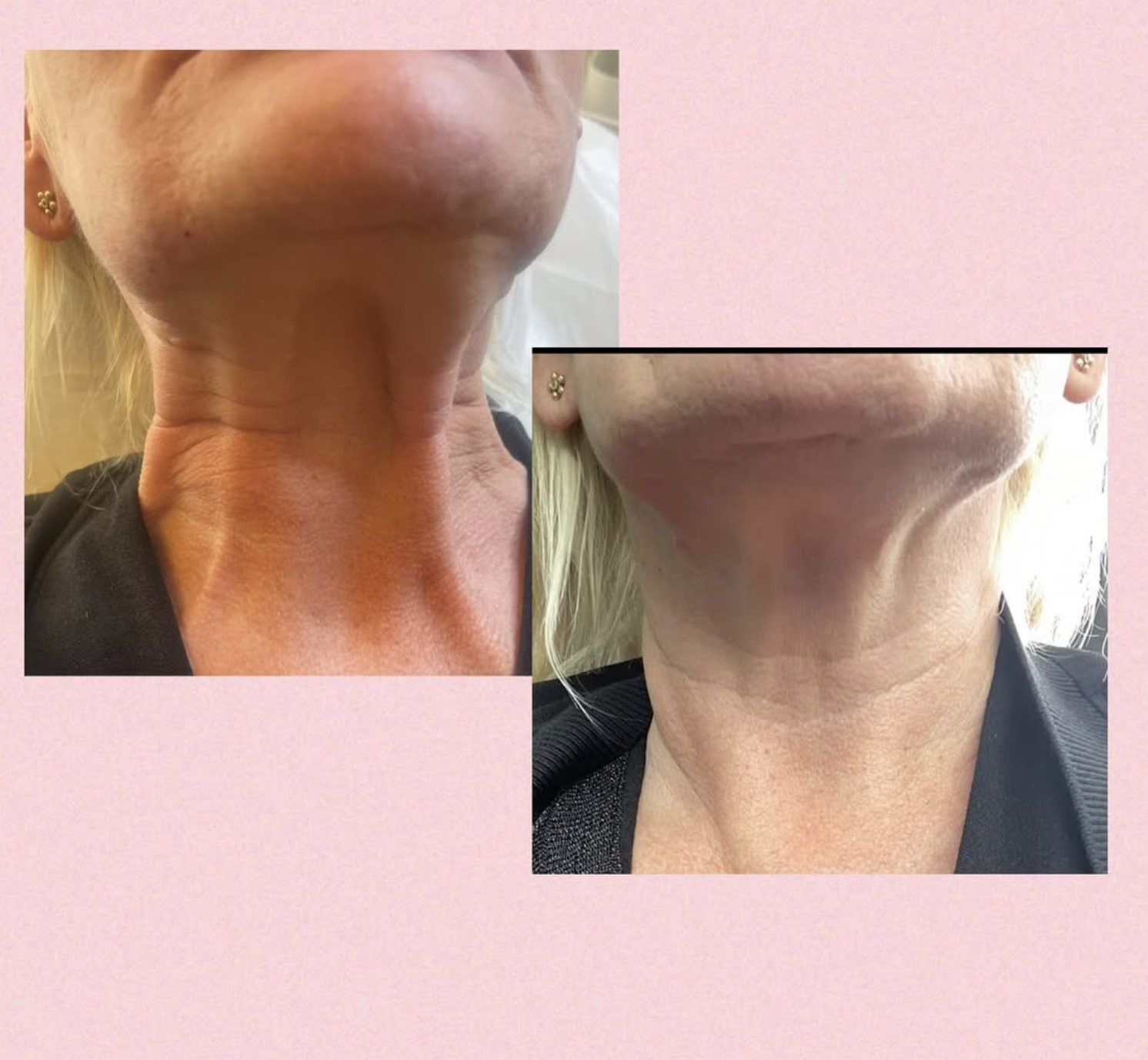 Naturlig botox behandling hos Klinik Skin Rehab i Charlottenlund
