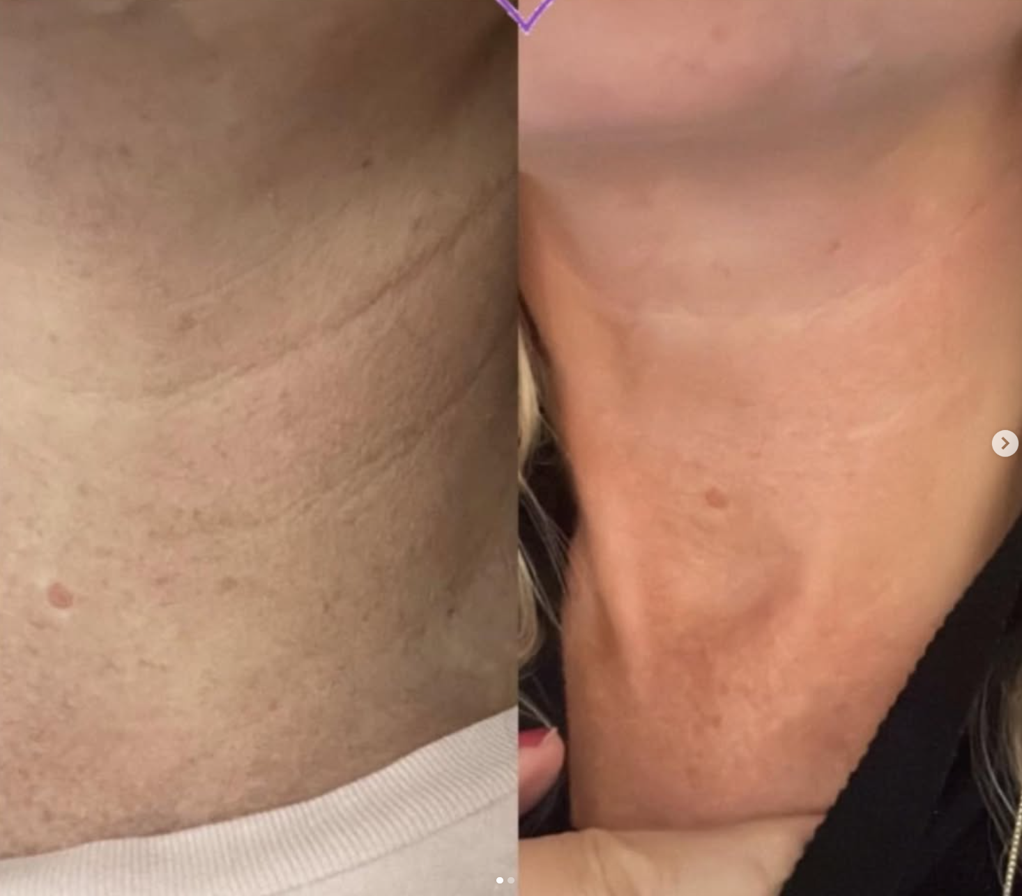 Microneedling hos Klinik Skin Rehab i Charlottenlund