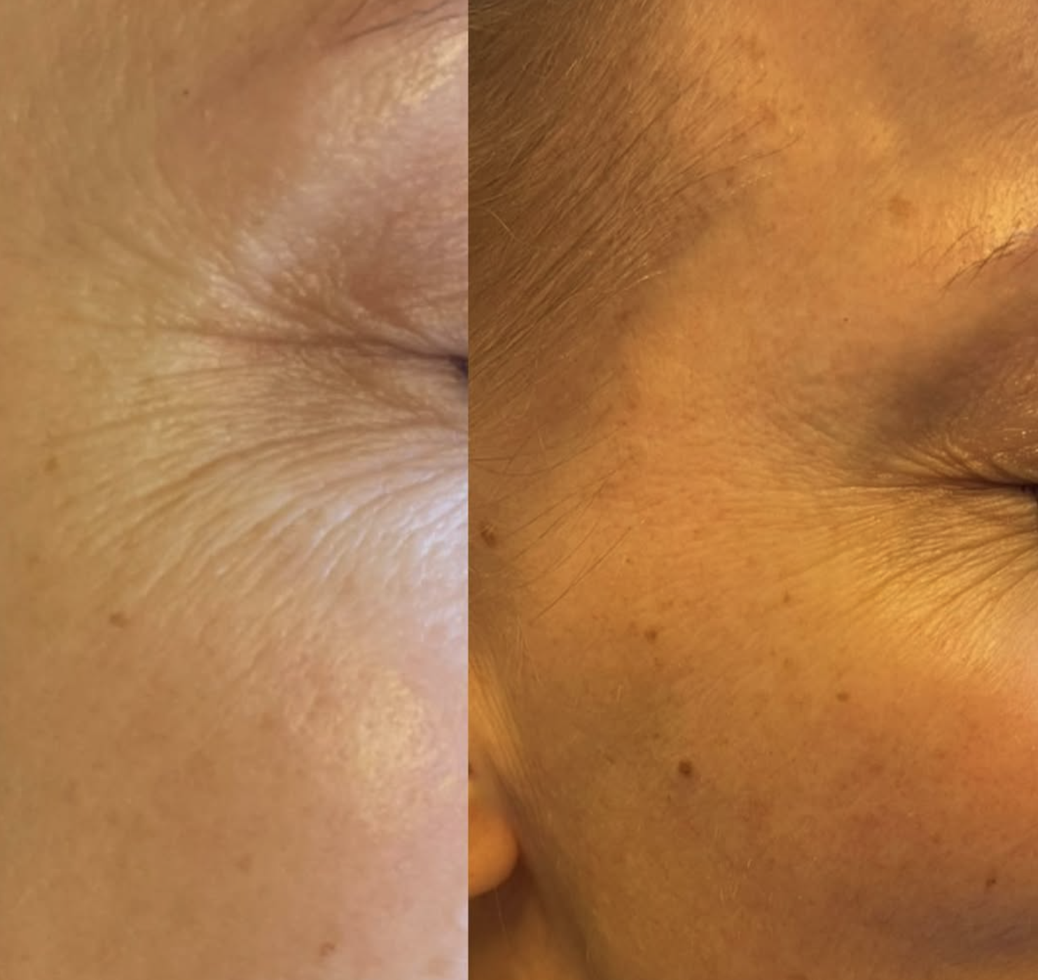 Før og efter billeder Klinik Skin Rehab i Charlottenlund og på Bornholm.