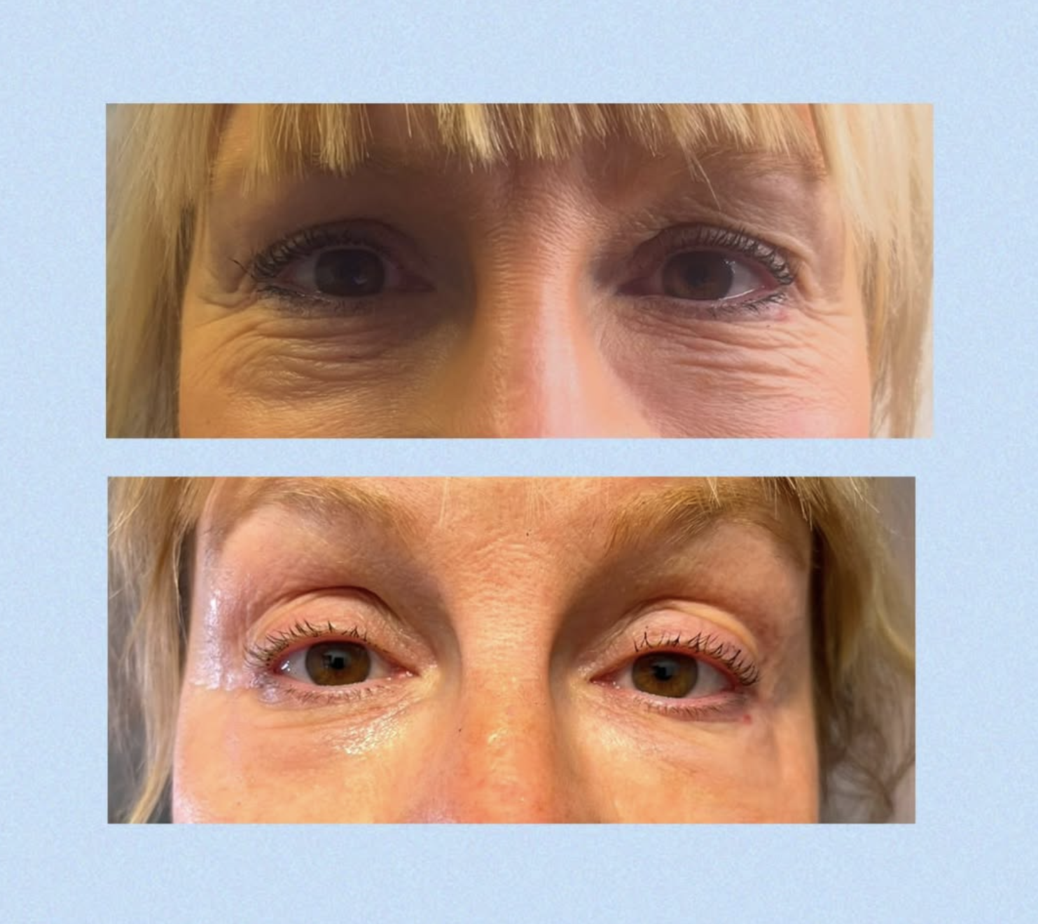 Før og efter billeder Klinik Skin Rehab i Charlottenlund og på Bornholm.