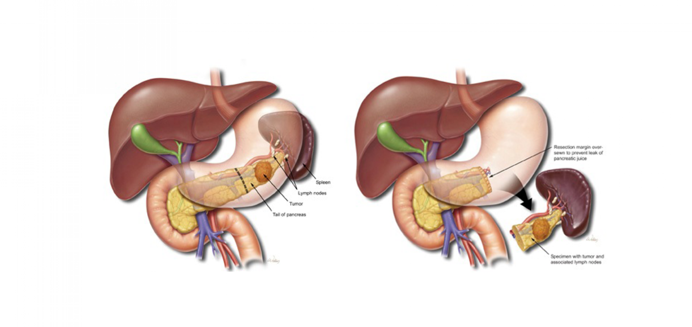 Diagram of distal pancreatectomy showing removal of the body and tail of the pancreas, often including the spleen.