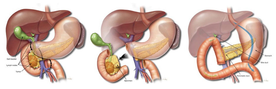 Diagram of the Whipple procedure (pancreaticoduodenectomy) showing removal of the pancreatic head, duodenum, bile duct, and gallbladder with reconstruction.