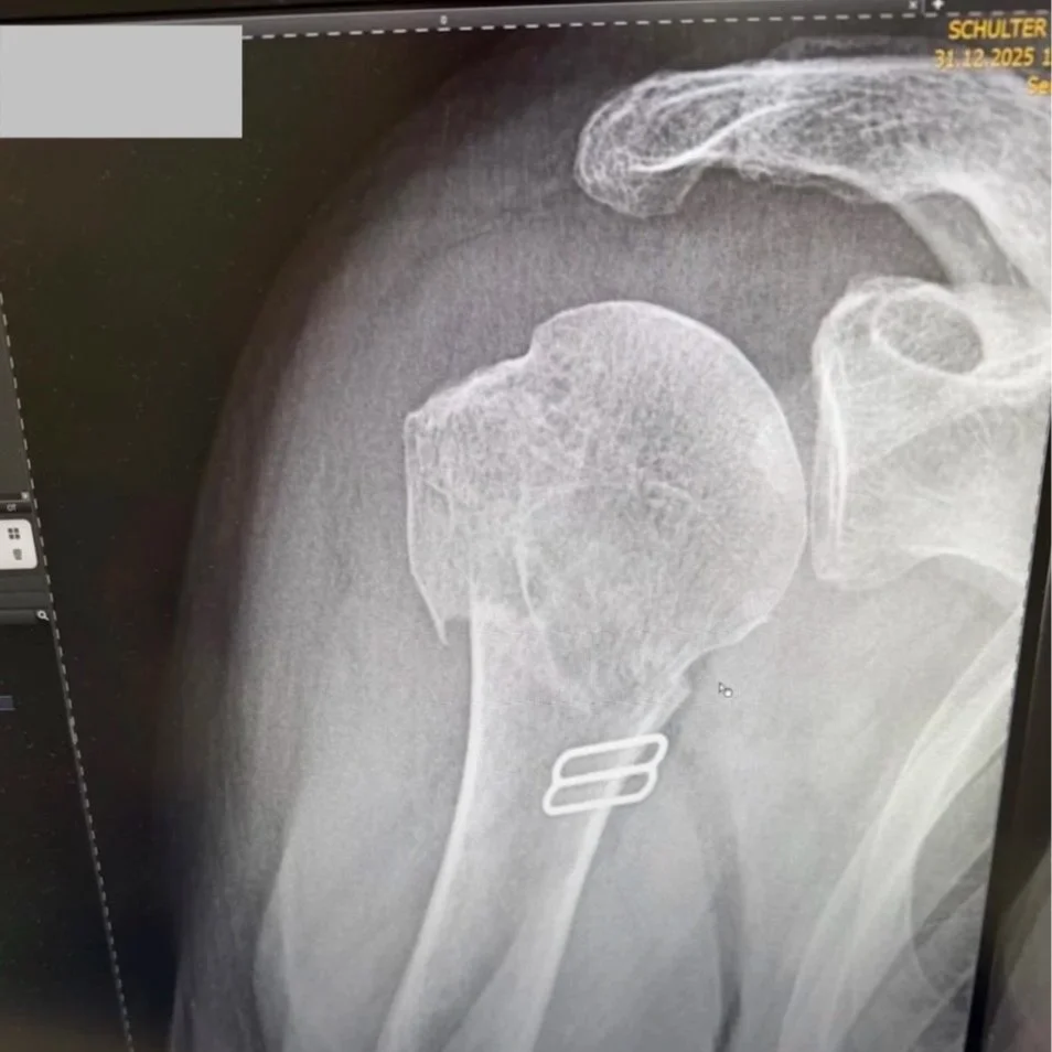 Initial radiograph - 31 December 2025