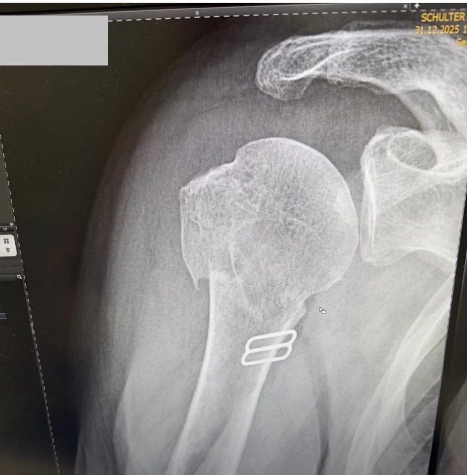 Anonymised initial radiograph showing shoulder fracture before Boon Elite Priority Access Support