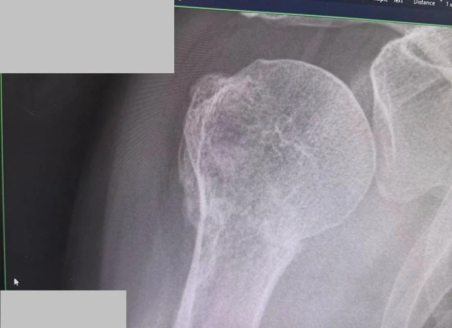Anonymised follow-up radiograph at five weeks confirming complete shoulder fracture healing