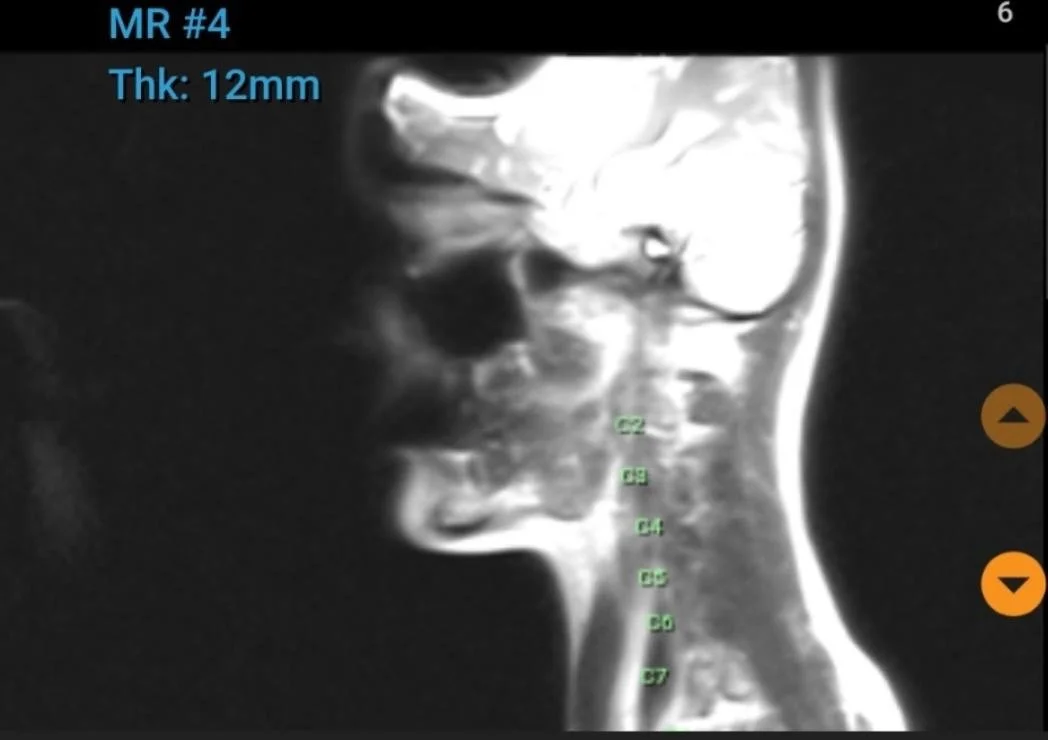 Does Brachycephaly Increase The Risk Of Syringomyelia?