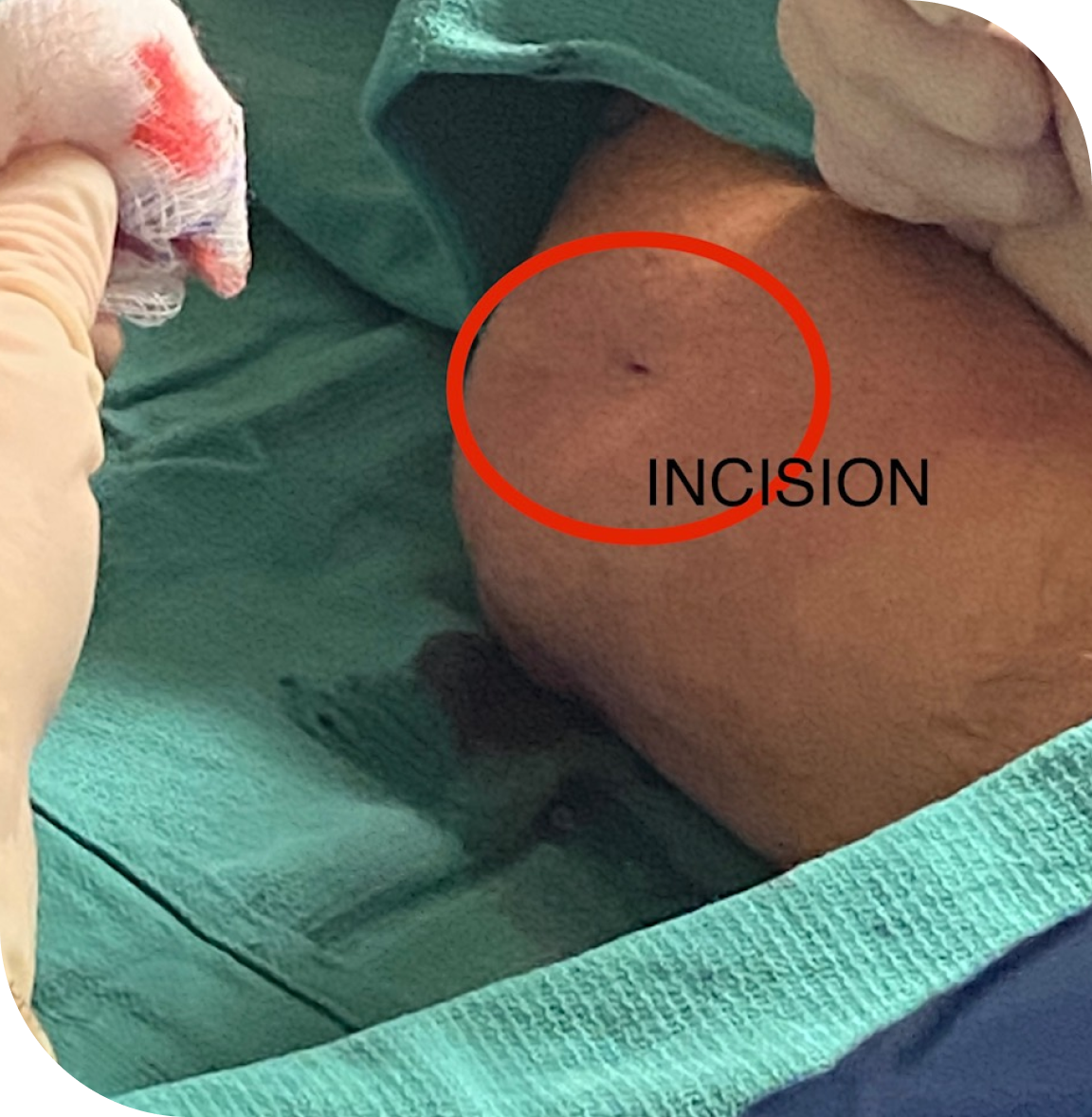 Tenex Procedure In Nashville TN