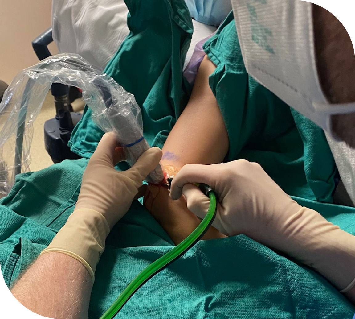 Tenex Procedure Plantar Fasciitis