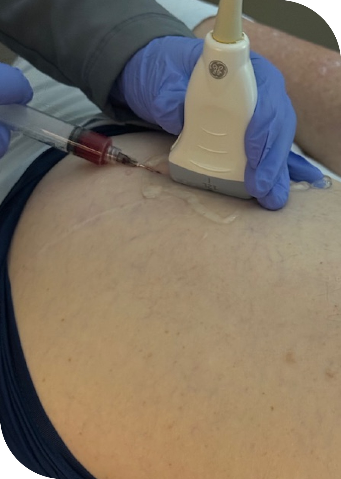 PRP Shoulder Injection Cost