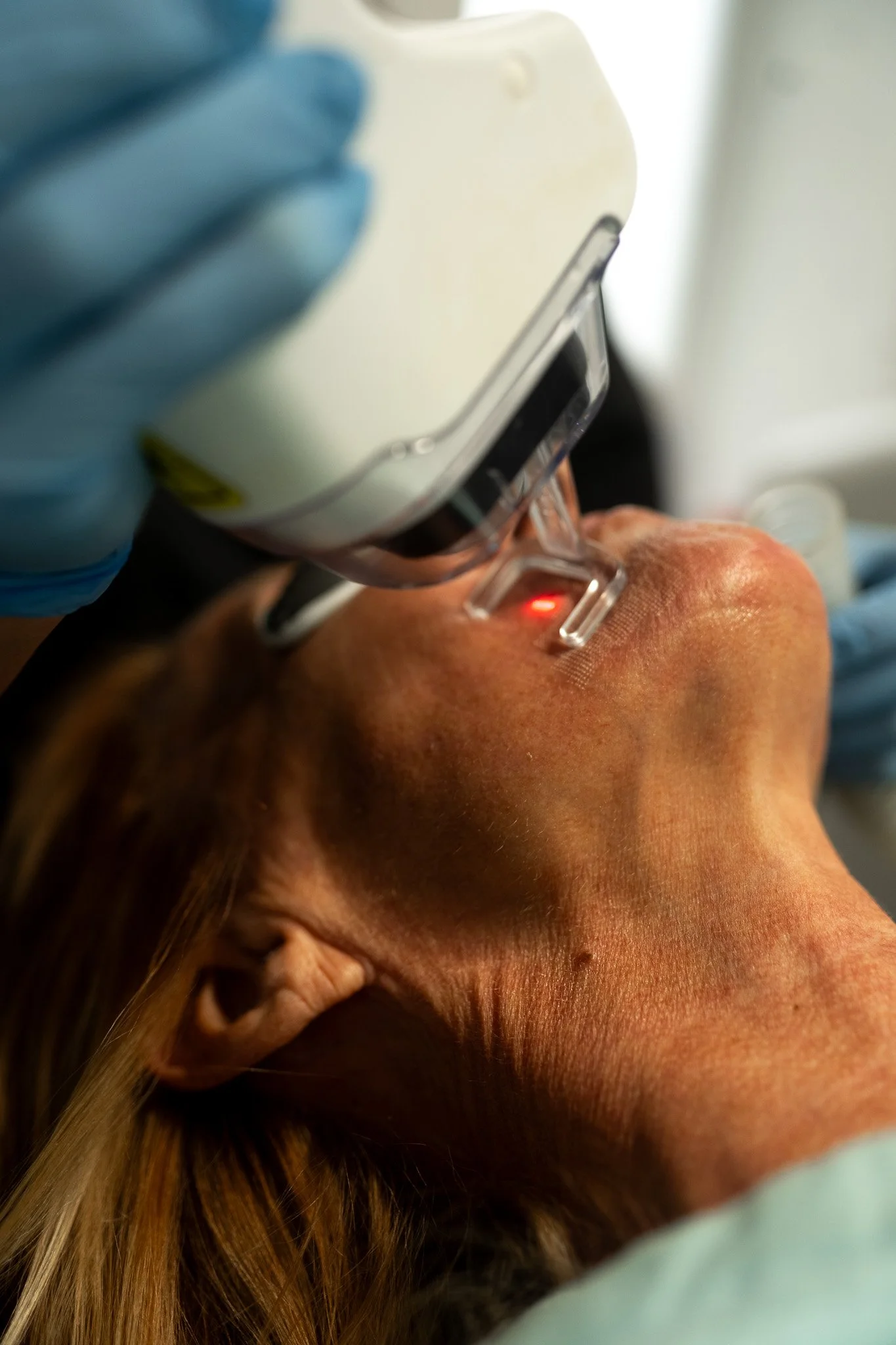 A person receiving a laser skin treatment on their face, with a device emitting a red light, while lying down.