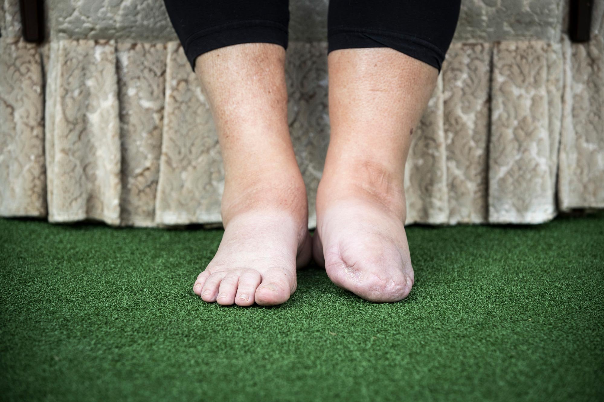 Pam Abraham's diabetes restricted the flow of blood to her leg so severely that the agony left her "clawing at the walls". Surgeries claimed the toes on her left foot, and an infection nearly killed her. Diabetes now causes close to 1000 amputations 