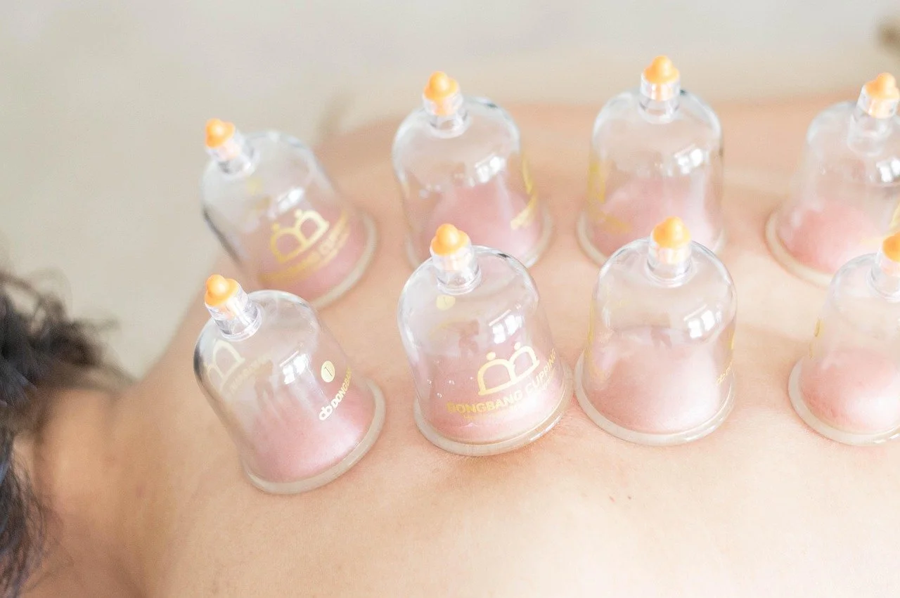 Cupping therapy cups placed on a person's back.