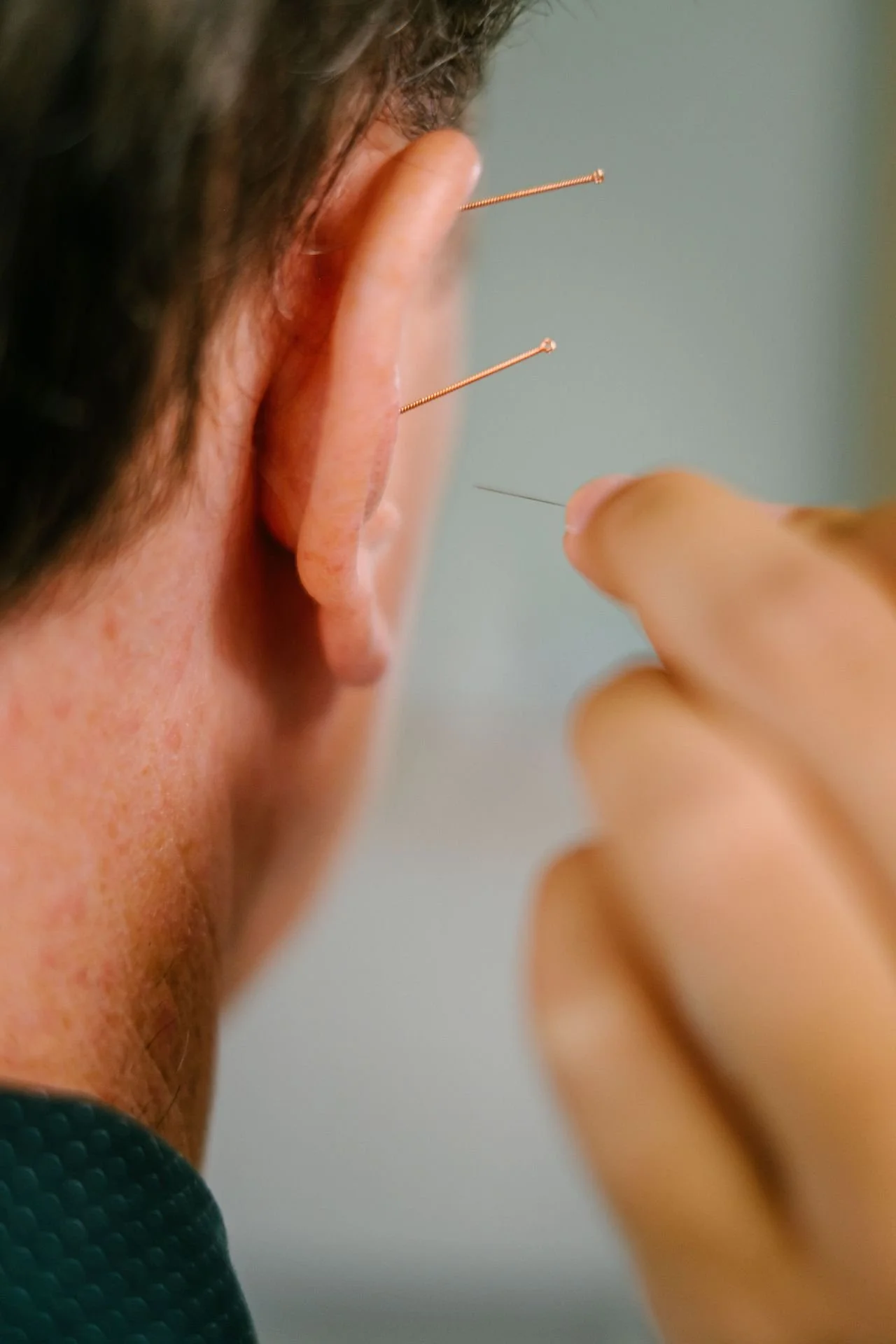 Gentle ear acupuncture treatment supporting nervous system regulation