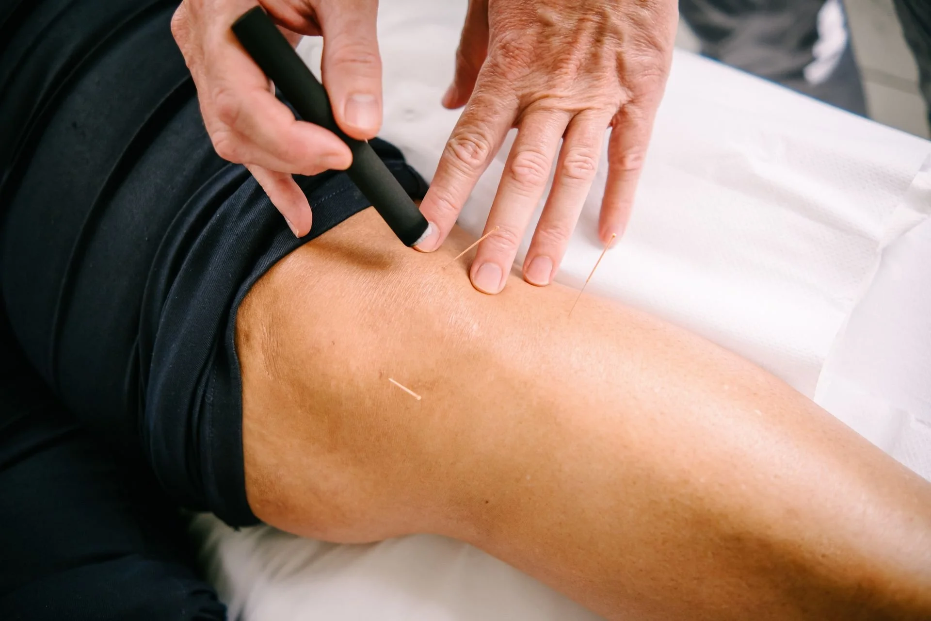 Precise acupuncture point selection and moxibustion during treatment for knee pain and recovery