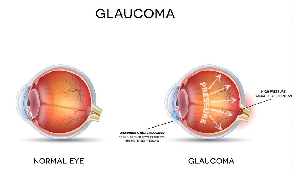 Glaucoma Screening and Management